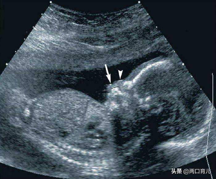 做四维彩超时，胎儿一直“微笑”，孕妈欣喜，医生：最好别生下来