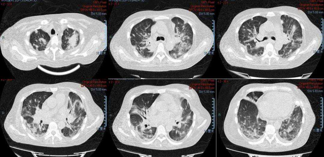 肺移植术后1年出现肺部阴影，现有病原学证据均无法解释新发病变