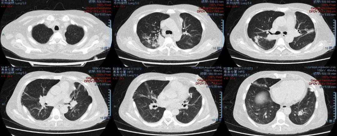 肺移植术后1年出现肺部阴影，现有病原学证据均无法解释新发病变